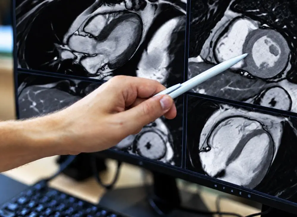 Médico señalando una resonancia magnética cardíaca en el monitor